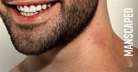 how long to hickeys last|how to fix a hickey.